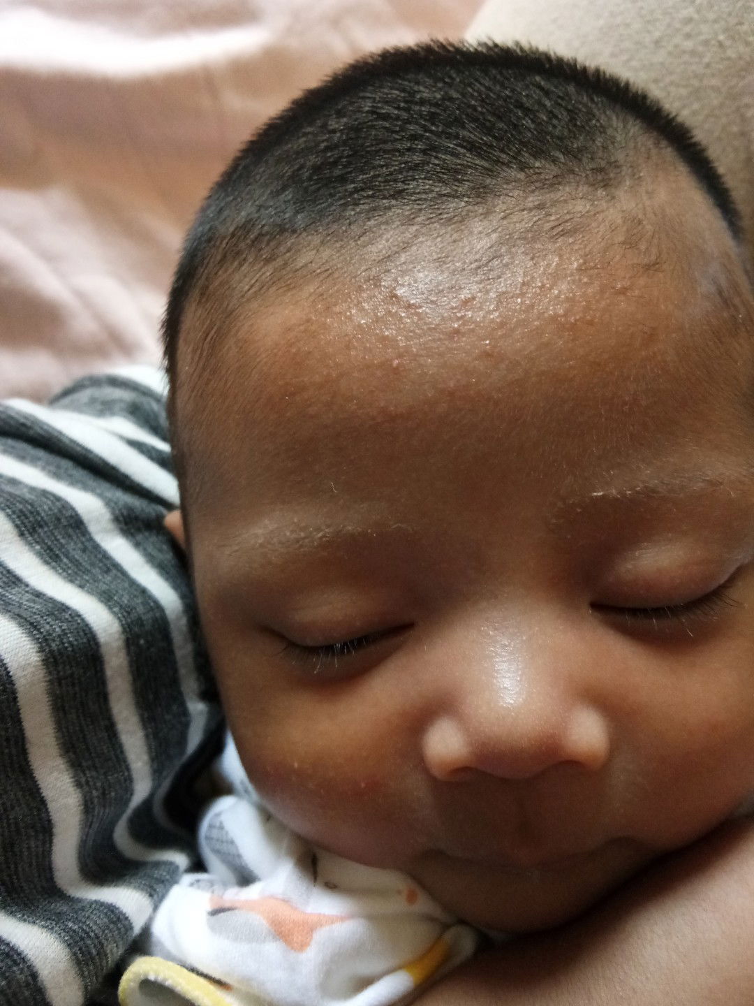 bruntus di dahi dan muka