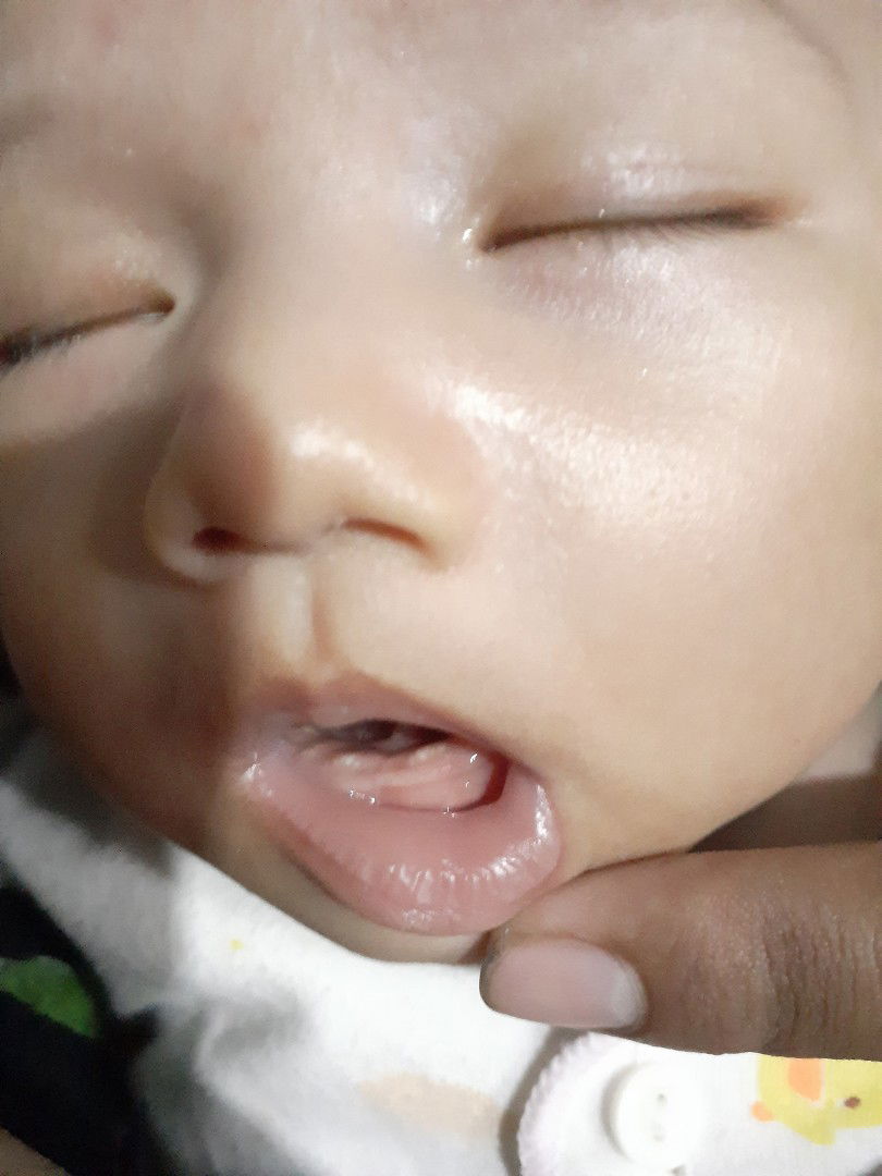 gusi Bayi ada bintik putih