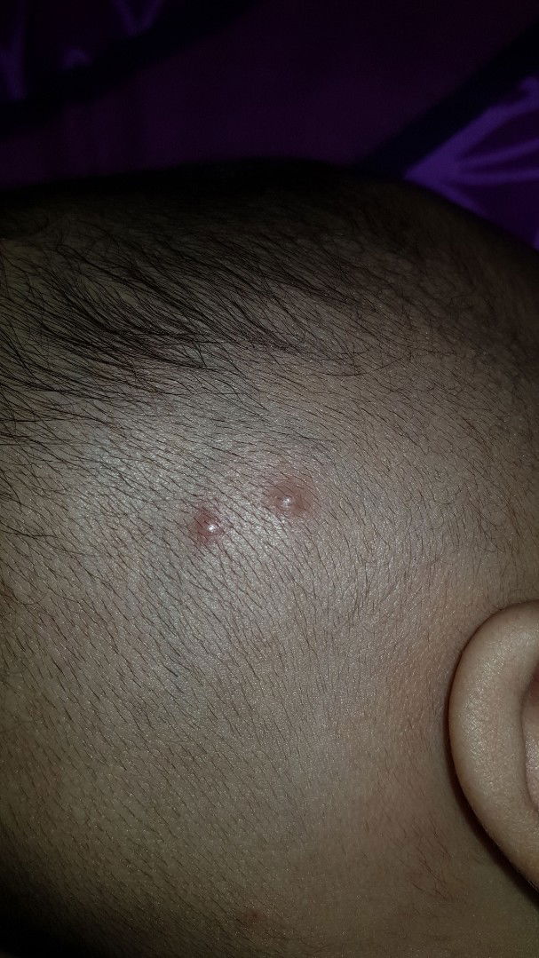 jerawat atau bisul pada bayi