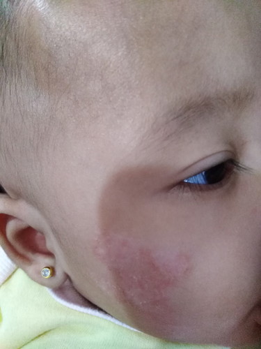 Rashes