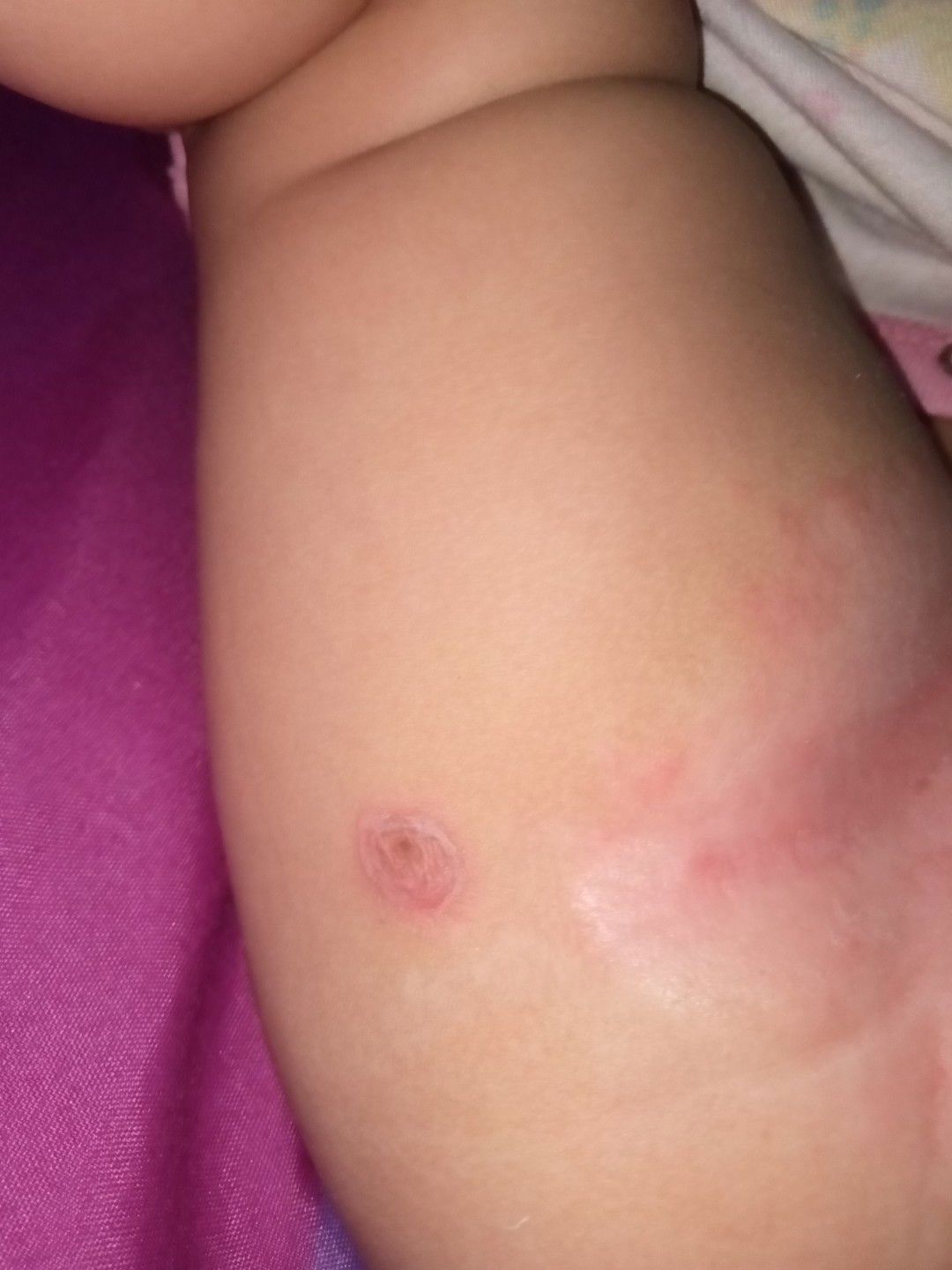 Bintik merah pada bayi