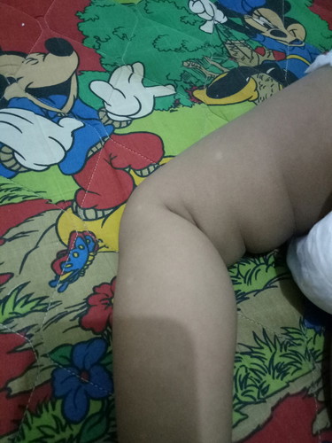 putihputih pada kulit bayi
