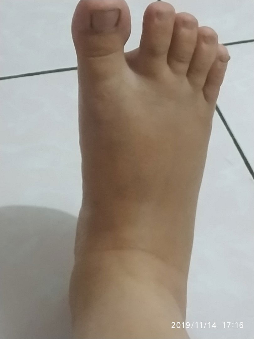 kaki bengkak setelah melahirkan