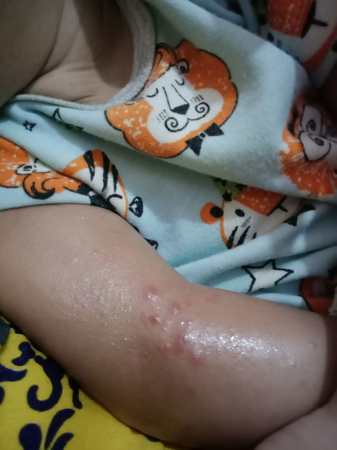 bentol gatal pada bayi