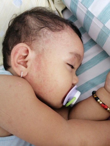 Pamumula Ng Balat Ni Baby