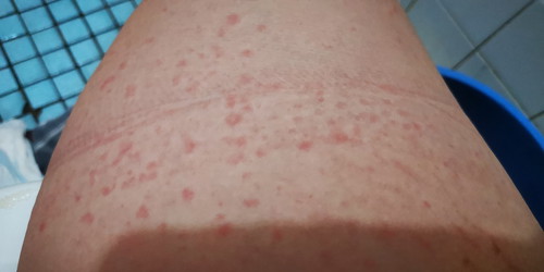 BARU LEPAS BERSALIN CAESER, TIMBUL BINTIK GATAL SELURUH BADAN & MUKA.