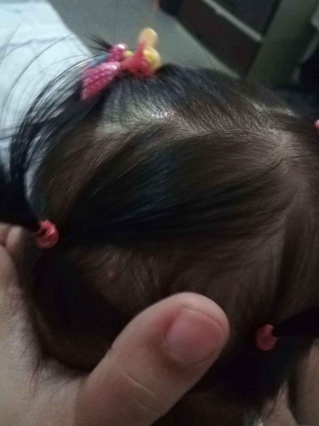 parang pimple sa ulo