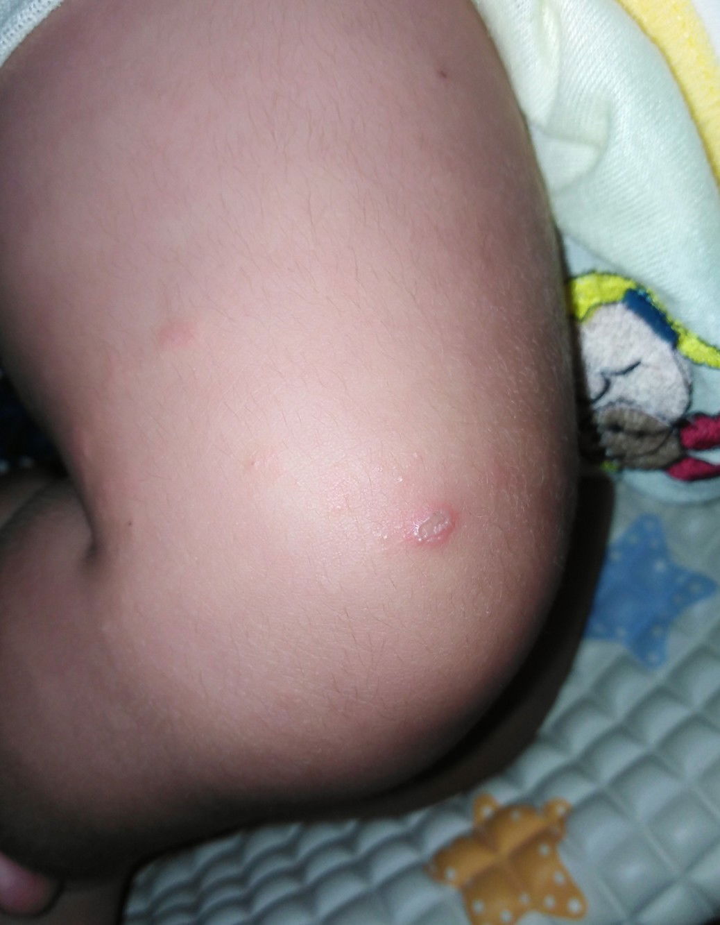 Luka di Kaki Baby