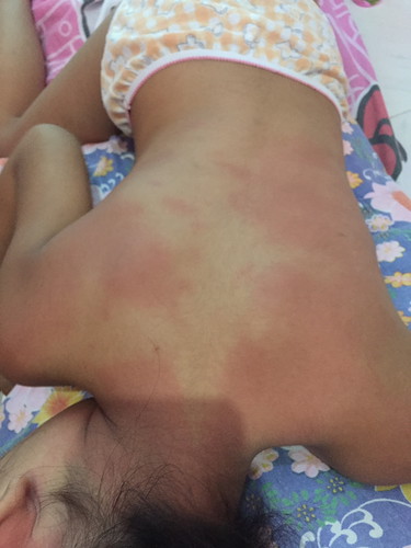 Kagat ng langgam or bed bugs?