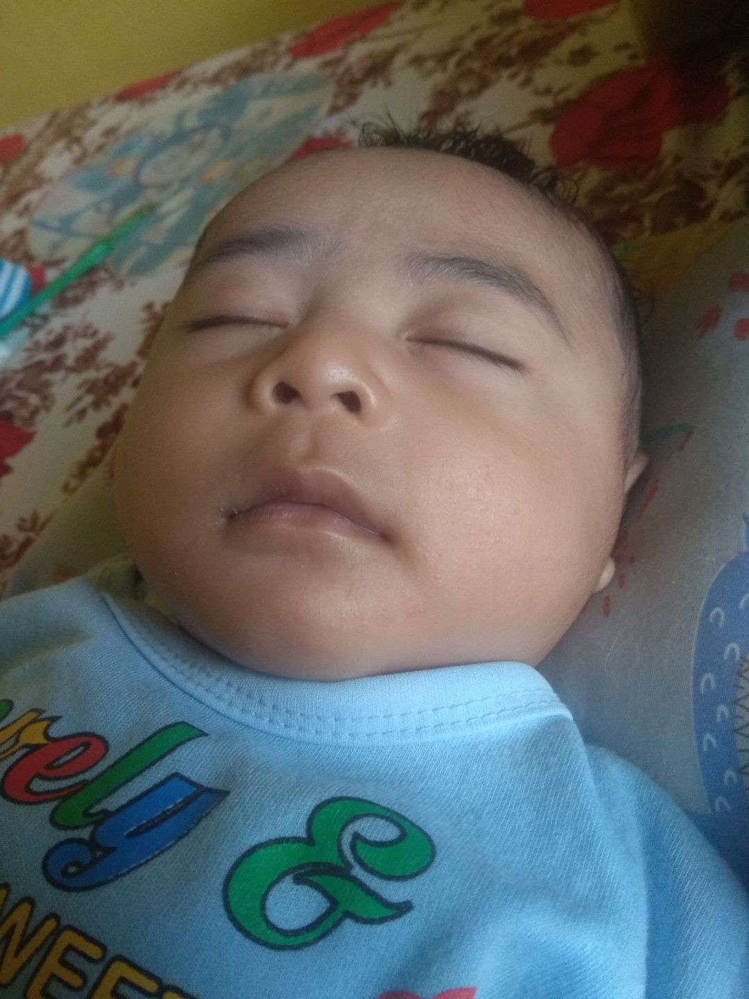 Bintik Kecil Dimuka Bayi