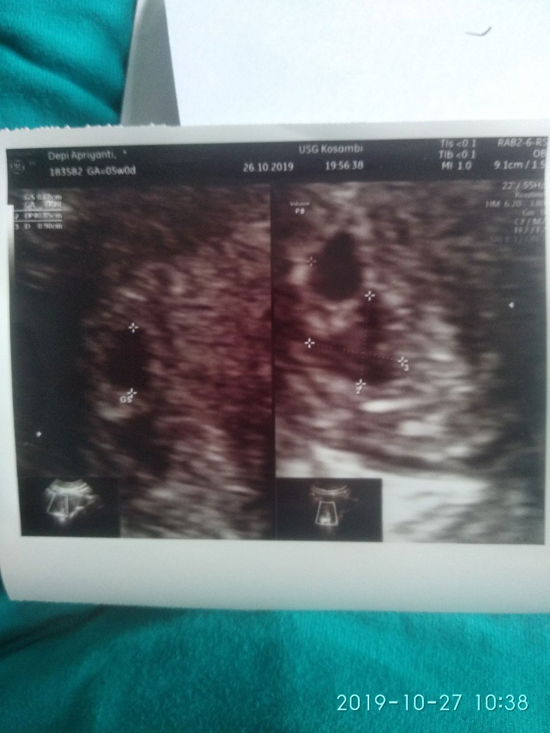 bercak darah disekitar rahim