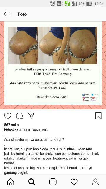 hamil perut gantung bisakah lahir normal ?