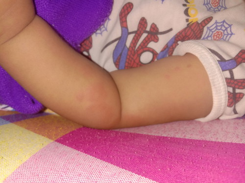 เป็นผื่นแดงอันตรายไหมค่ะ