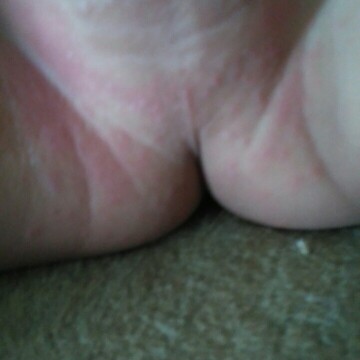 mohon solusi bunda, kenapa di bagian selakangan anak saya muncul bintik merah merah begini, tolong solusinya