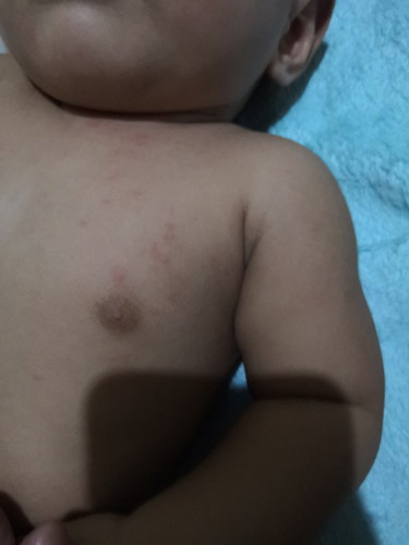 Rashes?
