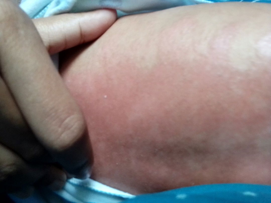 Ruam merah pada kulit bayi