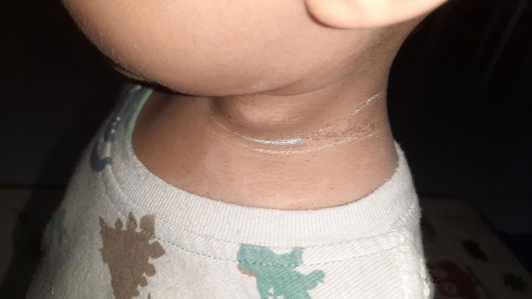 gatal2 pada saat menjelang tidur dan hanya didaerah sekitar dada ke atas