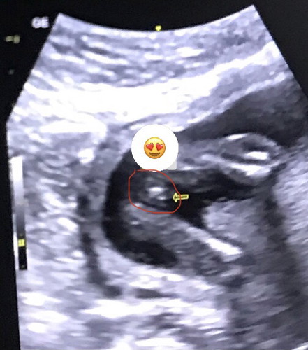 Not yet sure if boy or girl at 18 weeks