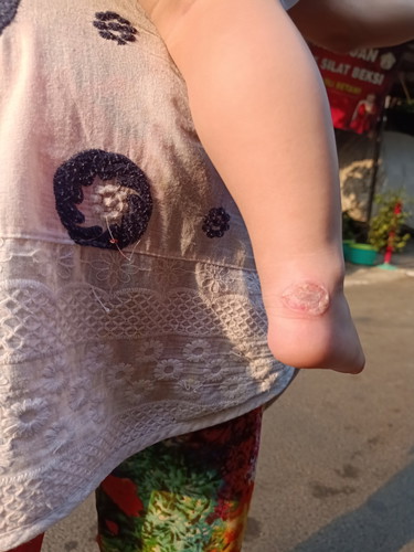 Kaki luka awal nya pakai sendal, mom tolong ini pakai apa ya klo bgini