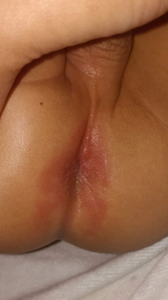 Merah pantat bayi
