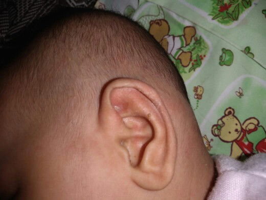 Daun Telinga Bernanah