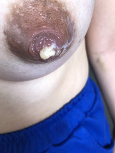 สอบถามเต้านมอักเสบ หัวนมแม่บวมเบ่ง