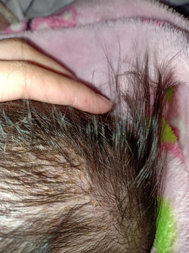 สะเก็ดสีเหลืองบนกระหม่อม