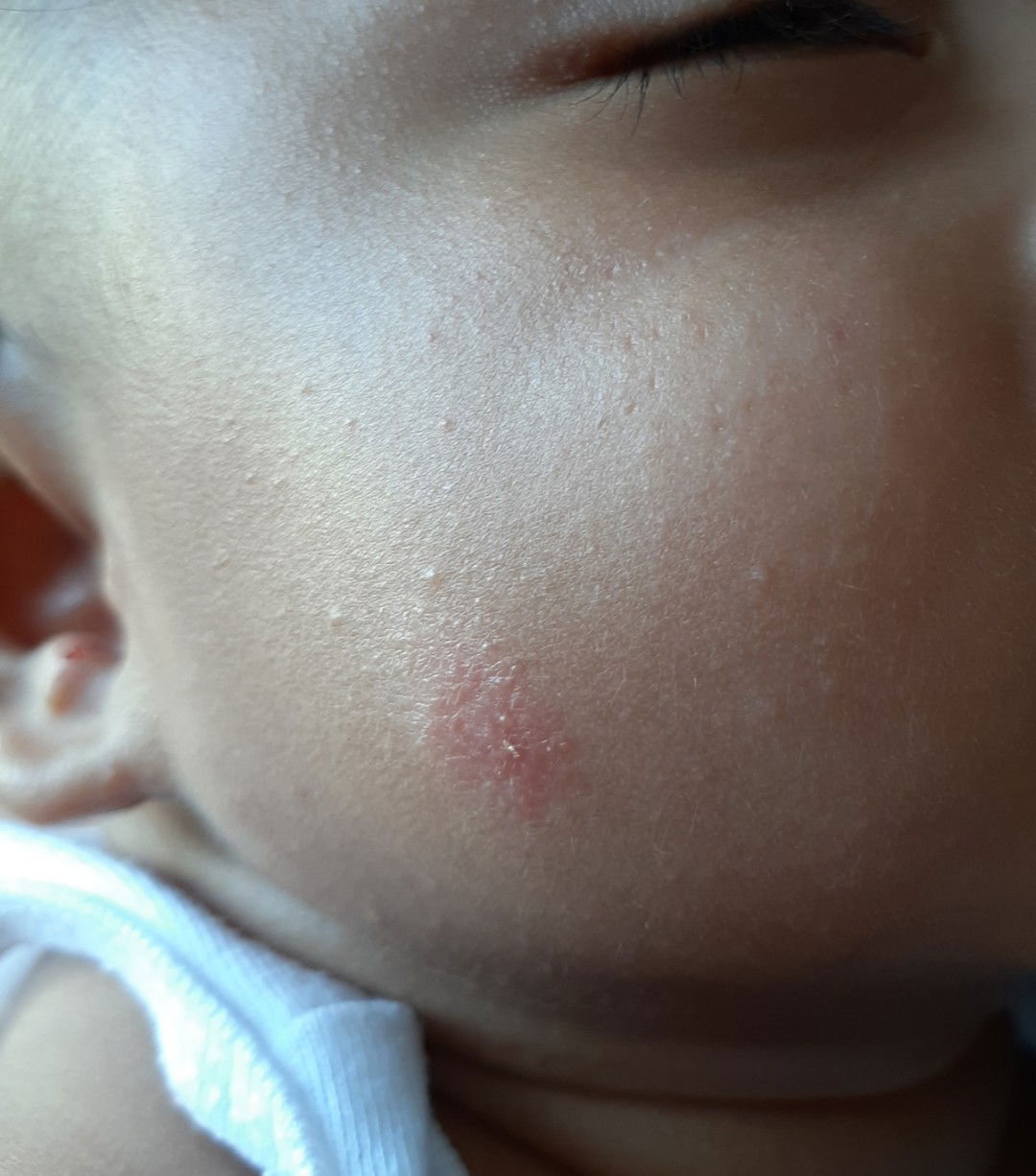 Red Spot on face