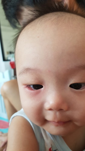 baby lower eye lid swollen