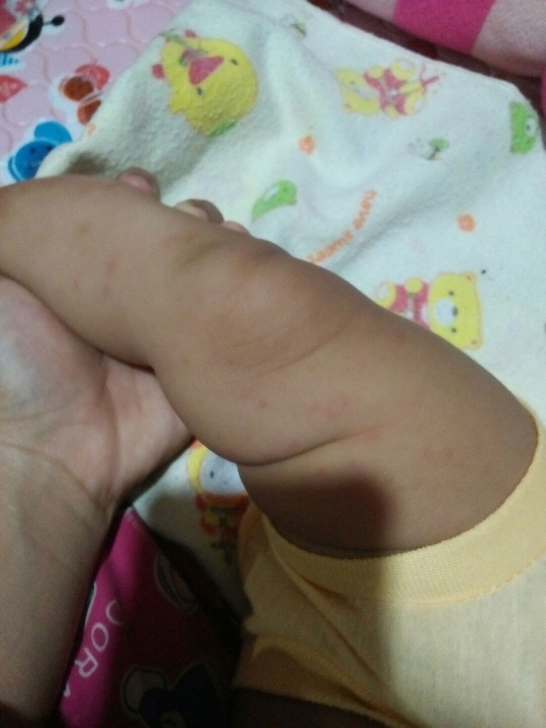 Alergi / Biang keringat