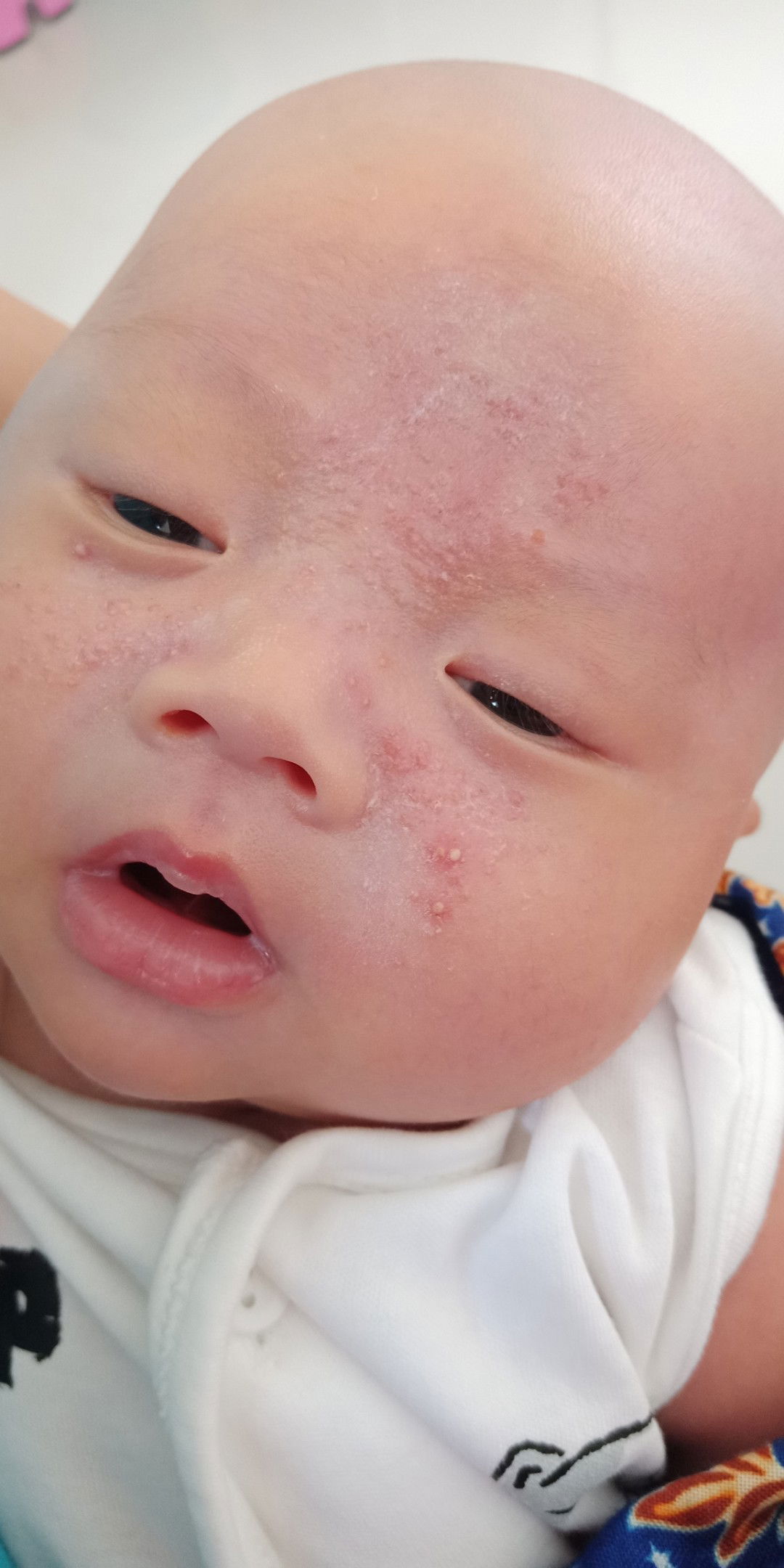 alergi atau hormon atau infeksi