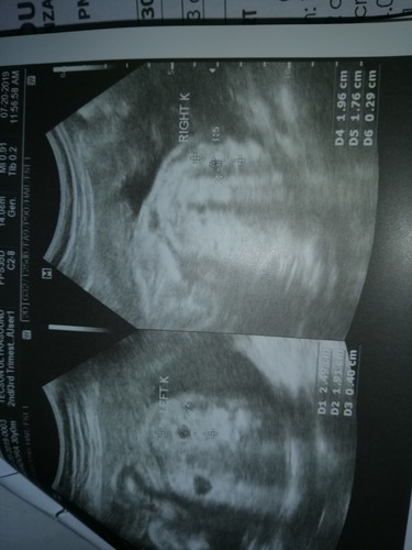 MONITOR RENAL PELVISES FOR SUBSEQUENT SCAN
