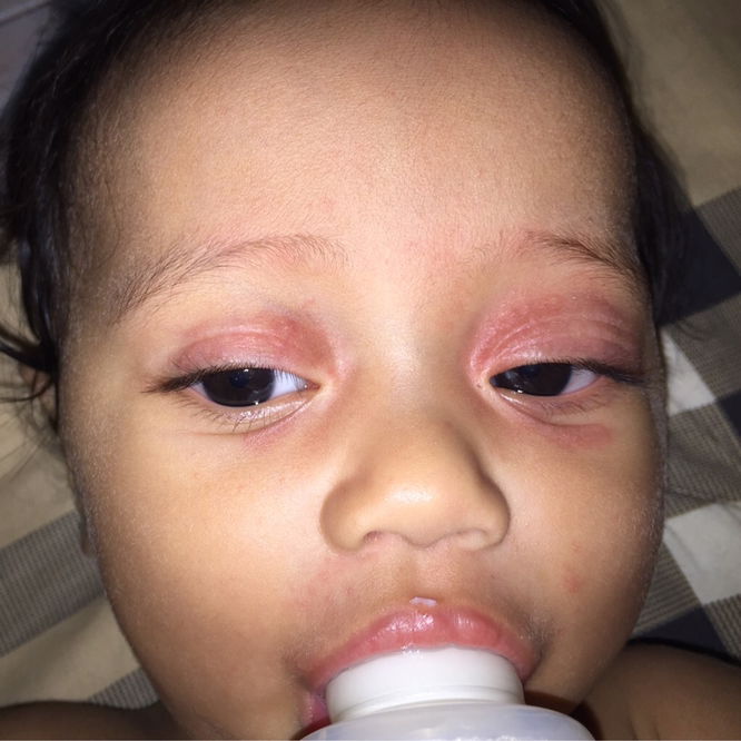 ผื่นแดงๆบนเปลือกตา