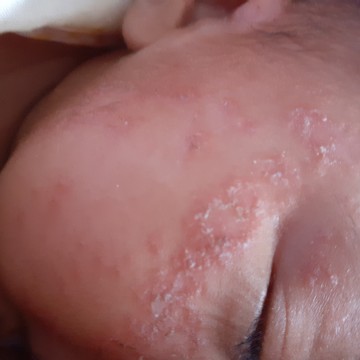 น้องเป็นแผล