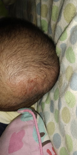Lecet di Kepala Bayi