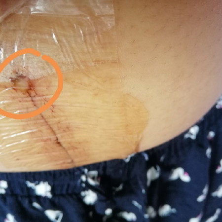 Cs Problem? 15 Days From Operation