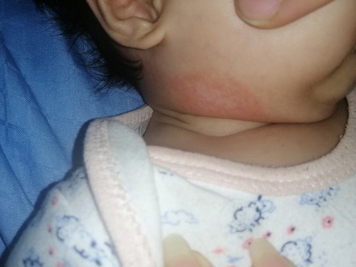 Rashes? Or Allergy?