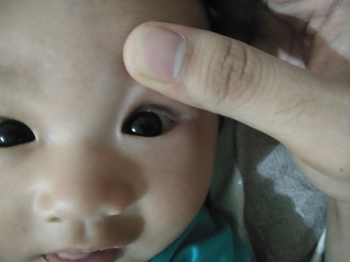 Butlig sa eyes