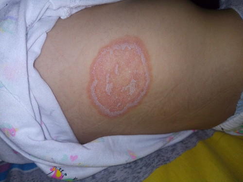 May ringworm si baby π