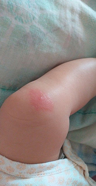 Kagat ng lamok? ipis? o langgam? kay baby