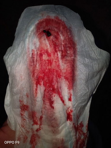 menstruation or bleeding