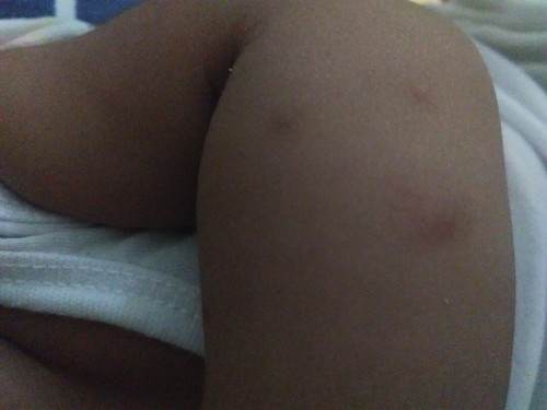 kagat ng lamok