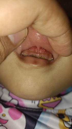 Assalamualaikum,ibu2 ada tak sesiapa yang tahu benjolan atas gigi anak sy ni apa?
