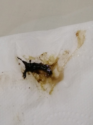 Brownish Discharge Or Spotting