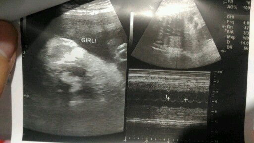 transverse baby at 36W2D