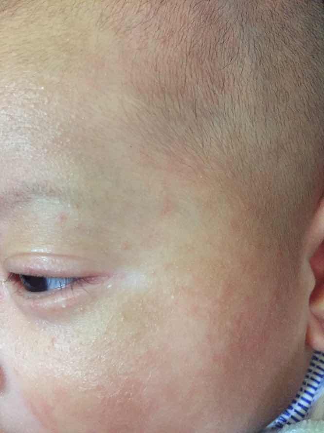 Bruntusan dikulit bayi