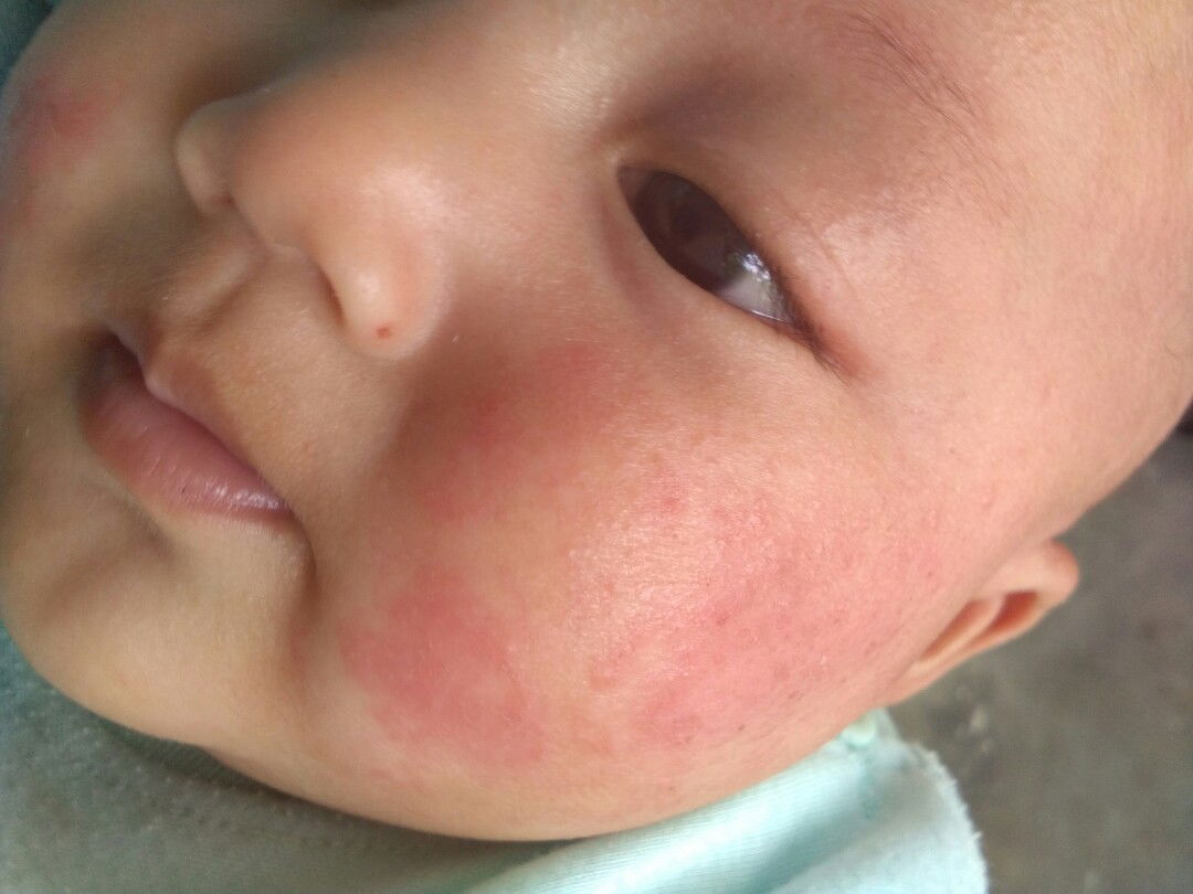 karna asi atau elergi