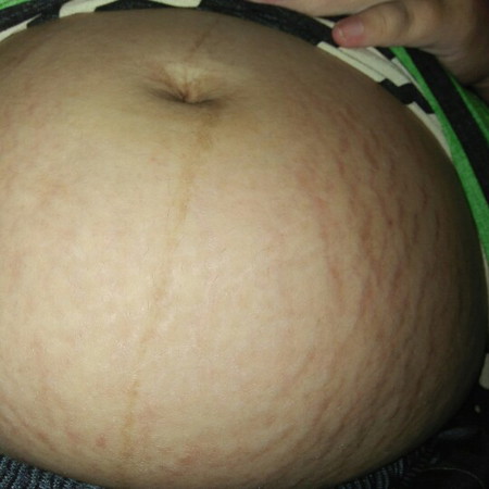 strech mark