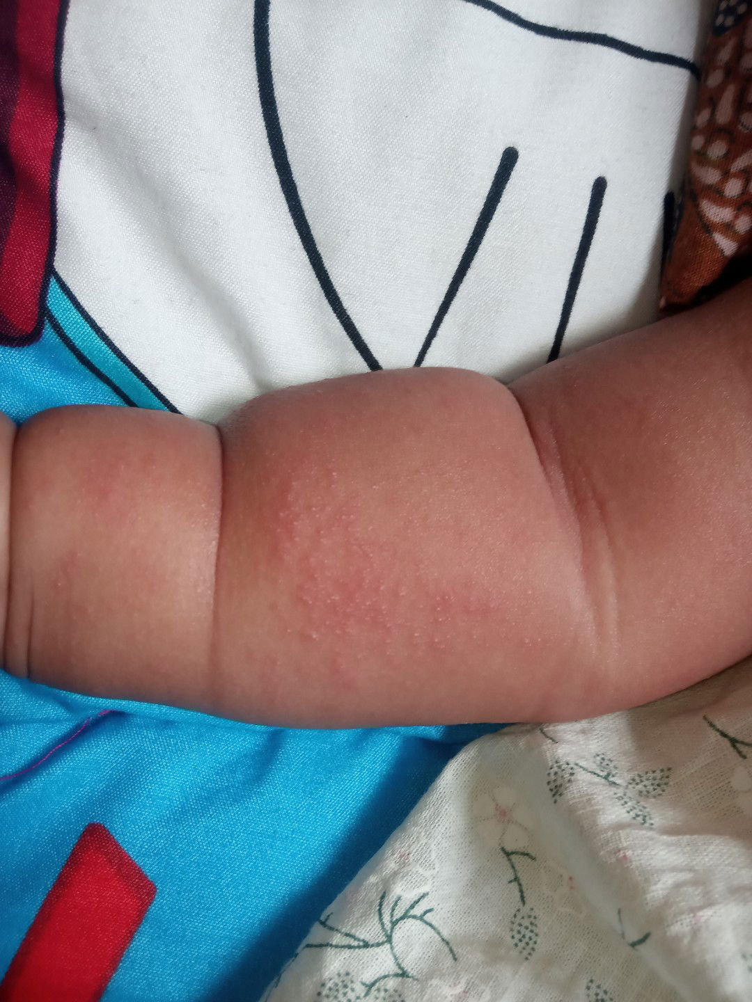 biang keringat pada bayi