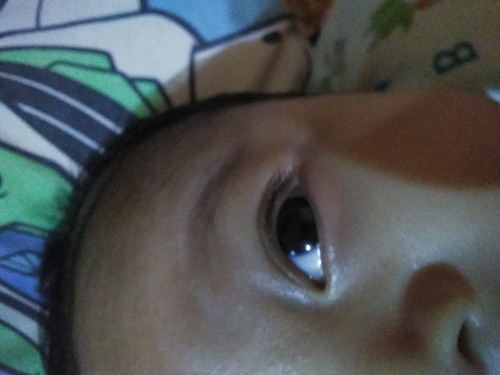 SAKIT MATA